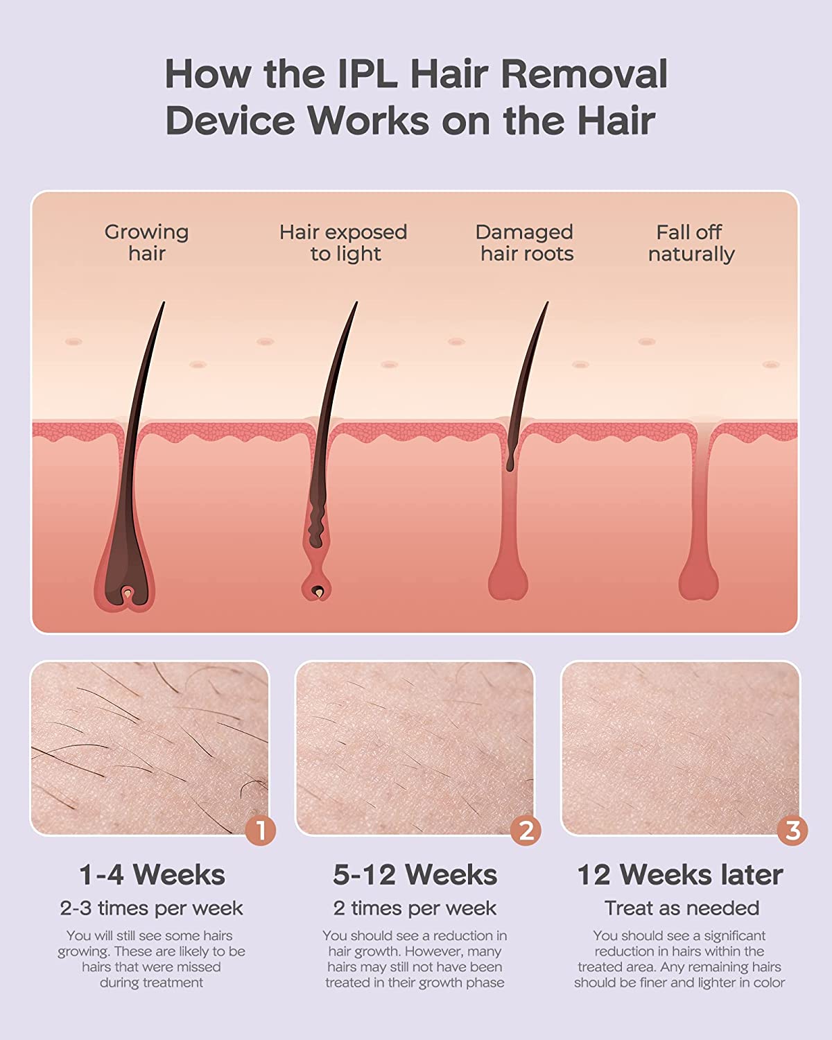 لیزر دائمی موهای زائد بدون درد INNZA مدل D-1176 - ارسال ۱۰ الی ۱۵ روز کاری